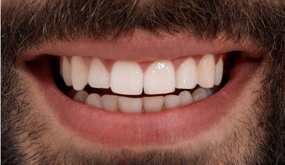 Zahnersatz mit Veneers – Alles, was Sie über Vorteile, Kosten & Alternativen wissen müssen